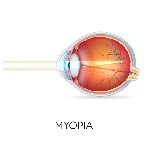 Myopia