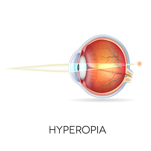 hyperopia