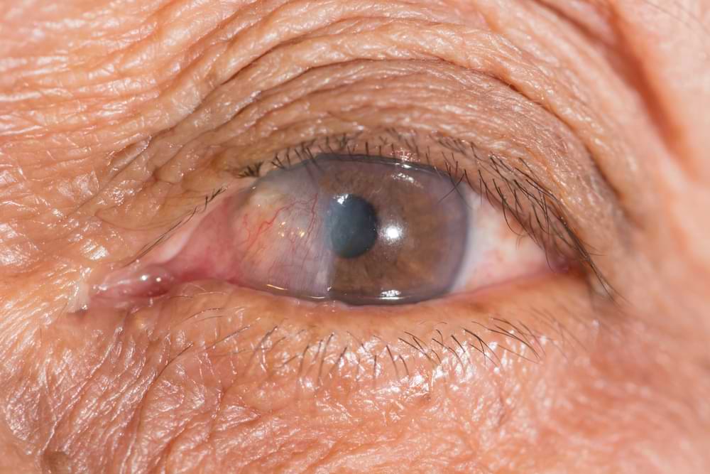 Pterygium causes and treatment