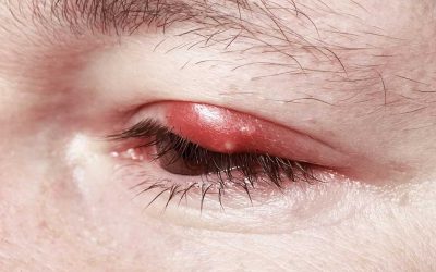 Who Can Treat Eye Infections in Australia?