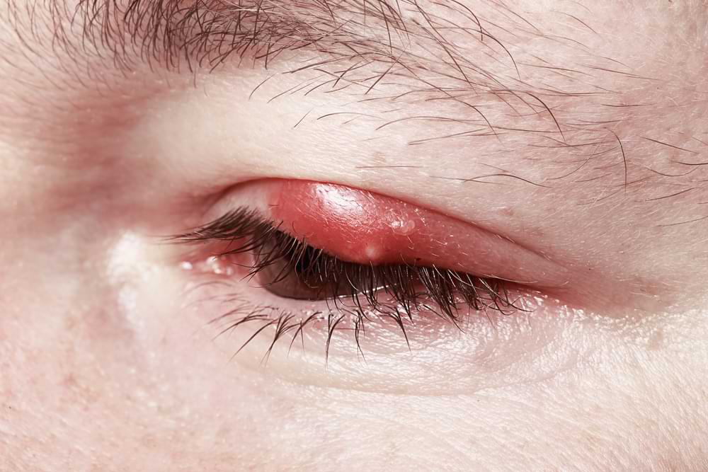 Who Can Treat Eye Infections in Australia?