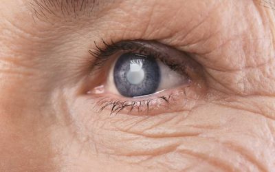 Cataracts: Causes, Symptoms, & Treatment